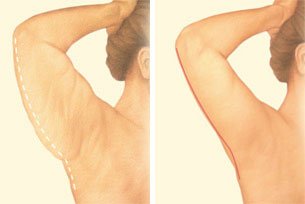 arm-lift-back-arm-incision