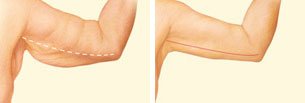 arm-lift-inner-arm-incision