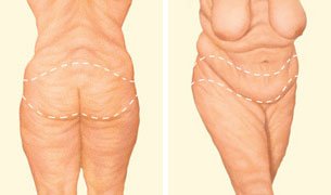 body-lifit-incision