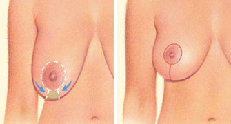 breast-lift-incision-areola-breast-crease