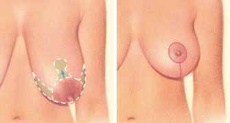 breast-lift-incision-areola-horizontal