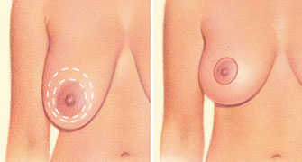breast-lift-incision-around-areola
