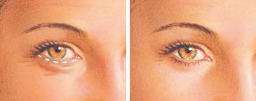 eyelid-surgery-lower-eyelid-incision