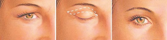 eyelid-surgery-upper-eyelid-incision