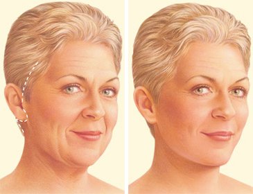 facelift-surgery-traditional-incision