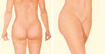 liposuction-after-buttock-thighs-stomach