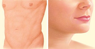 liposuction-after-stomach-breasts-chin
