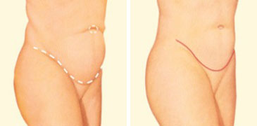 tummy-tuck-side-before-after