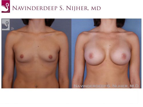Before and after image of a real plastic surgery procedure performed by Dr. Nijher.