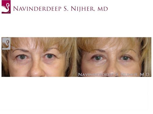 Eyelid Surgery Case #44894 (Image 1)