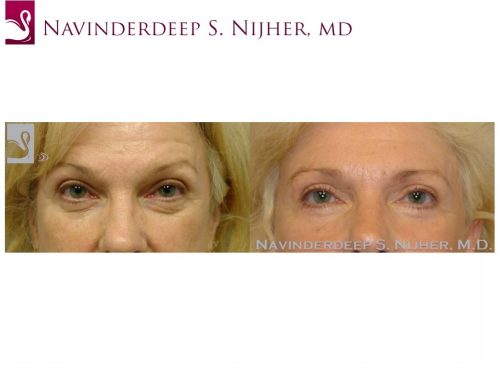 Eyelid Surgery Case #37215 (Image 1)