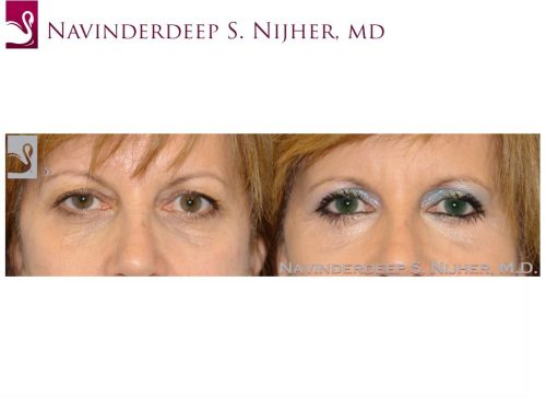 Eyelid Surgery Case #26493 (Image 1)