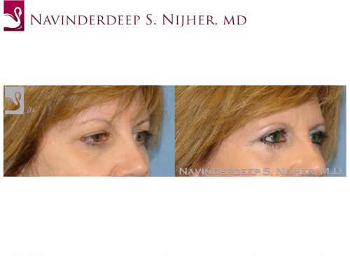 Eyelid Surgery Case #26493 (Image 2)