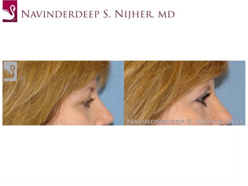 Eyelid Surgery Case #26493 (Image 3)