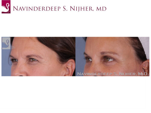 Eyelid Surgery Case #49794 (Image 2)