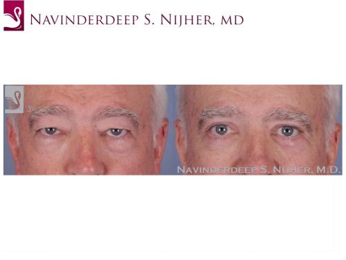 Eyelid Surgery Case #51894 (Image 1)