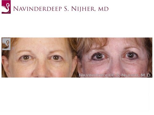Eyelid Surgery Case #52651 (Image 1)