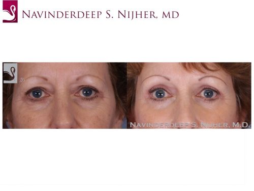 Eyelid Surgery Case #51160 (Image 1)