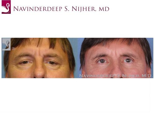 Eyelid Surgery Case #48316 (Image 1)
