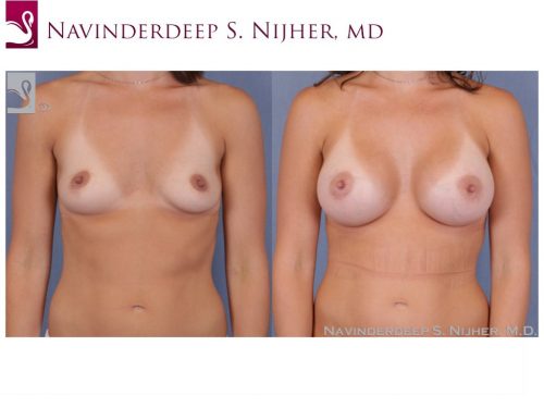 Breast Augmentation Case #50854 (Image 1)