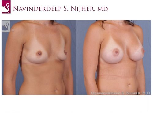 Breast Augmentation Case #50854 (Image 2)