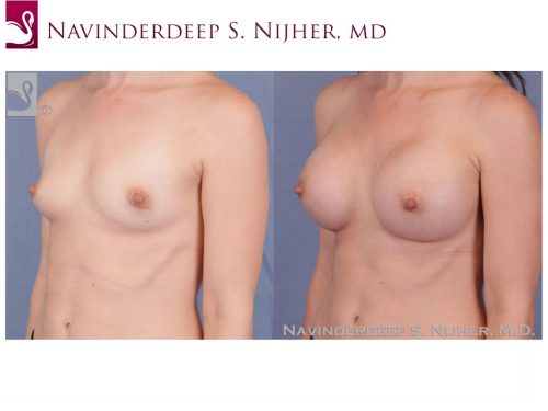 Breast Augmentation Case #52110 (Image 2)