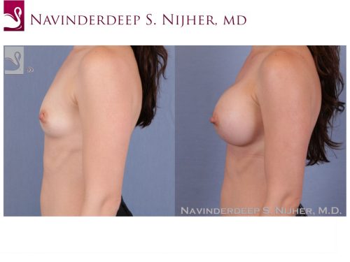 Breast Augmentation Case #52110 (Image 3)