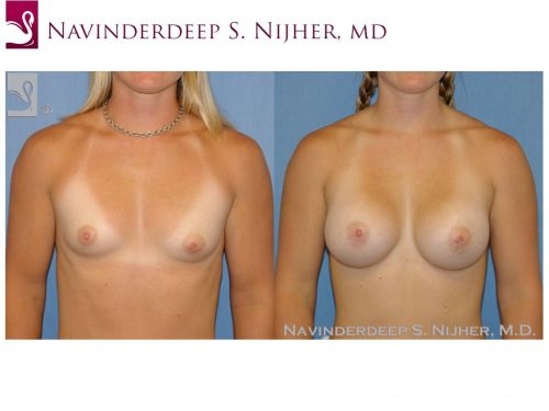 Breast Augmentation Case #45958 (Image 1)