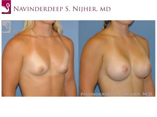 Breast Augmentation Case #45958 (Image 2)