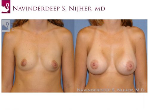 Breast Augmentation Case #39783 (Image 1)