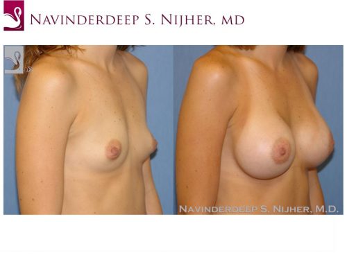 Breast Augmentation Case #39783 (Image 2)