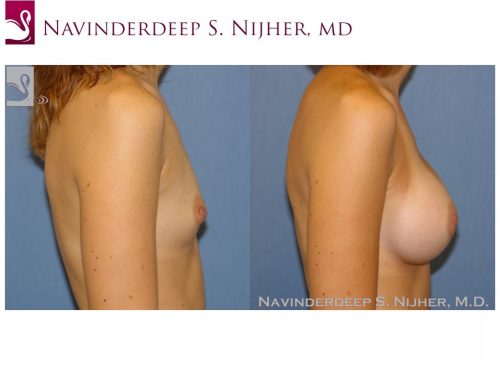 Breast Augmentation Case #39783 (Image 3)