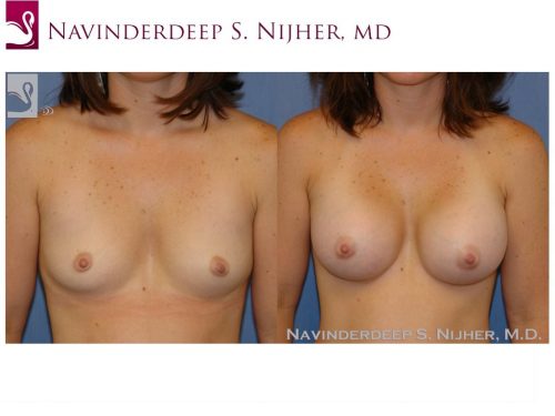 Breast Augmentation Case #42871 (Image 1)