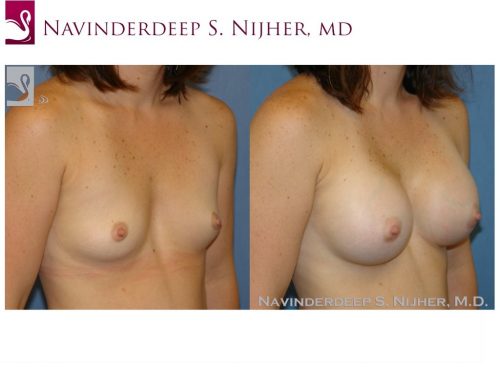 Breast Augmentation Case #42871 (Image 2)