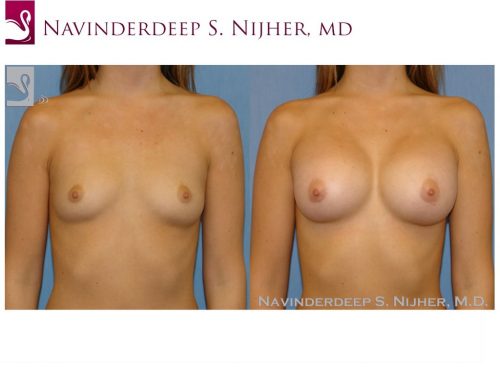 Breast Augmentation Case #49149 (Image 1)