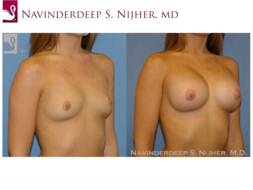 Breast Augmentation Case #49149 (Image 2)