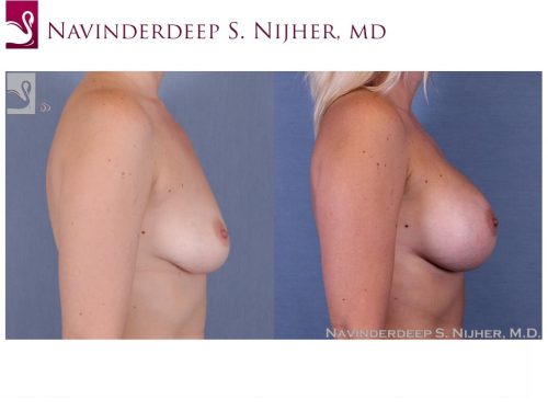 Breast Augmentation Case #40399 (Image 3)