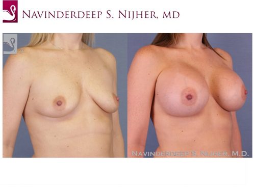 Breast Augmentation Case #52586 (Image 2)