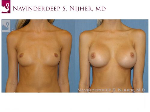 Breast Augmentation Case #48471 (Image 1)