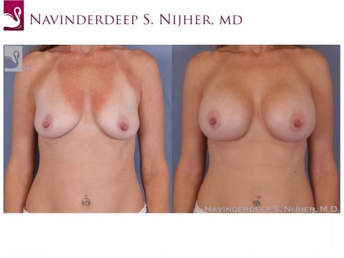 Breast Augmentation Case #39608 (Image 1)