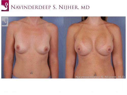 Breast Augmentation Case #50168 (Image 1)