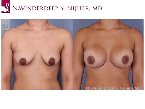 Breast Augmentation Case #50195 (Image 1)