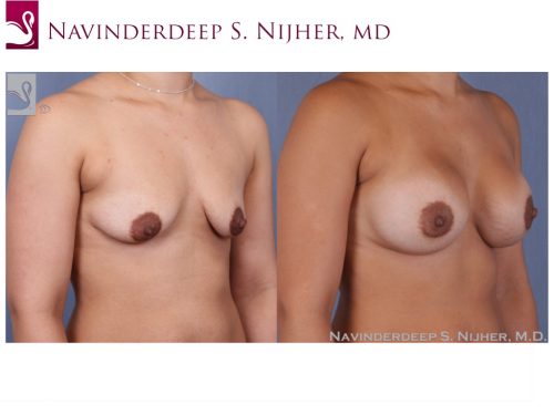 Breast Augmentation Case #50195 (Image 2)