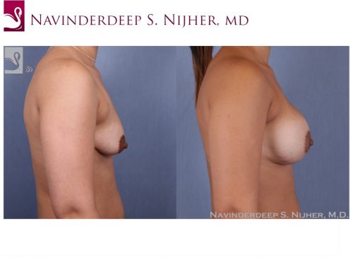 Breast Augmentation Case #50195 (Image 3)