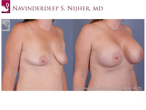 Breast Augmentation Case #23428 (Image 2)