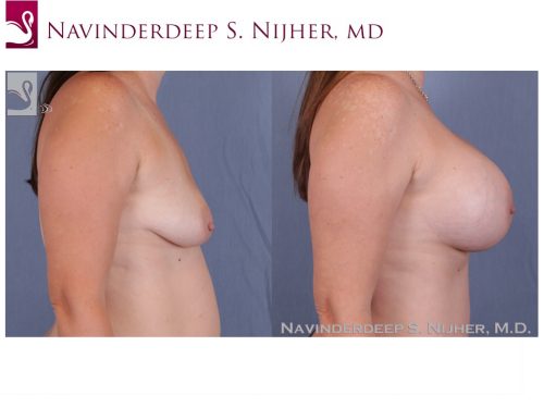 Breast Augmentation Case #23428 (Image 3)