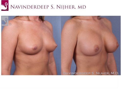 Breast Augmentation Case #50343 (Image 2)