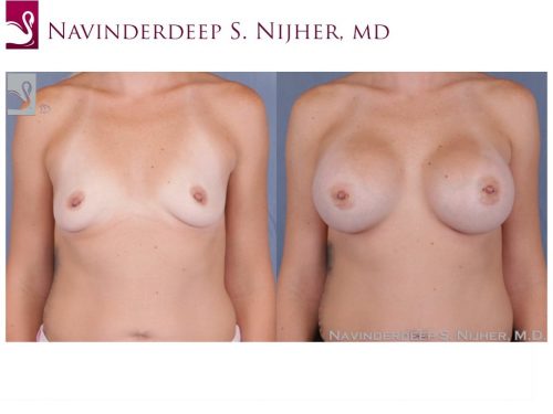 Breast Augmentation Case #51310 (Image 1)