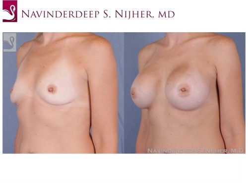 Breast Augmentation Case #51310 (Image 2)