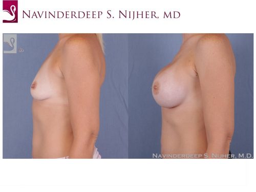 Breast Augmentation Case #51310 (Image 3)